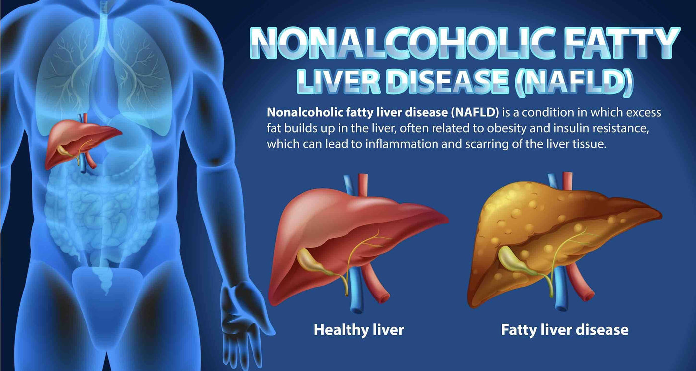 Why is non alcoholic fatty liver disease so common?